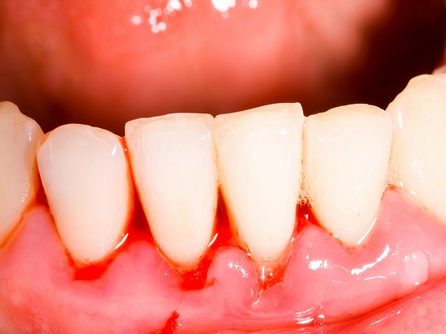 Nướu bị đau khi chạm vào hoặc bị chảy máu trong và sau khi đánh răng là một trong những triệu chứng ở bệnh nhân mắc bệnh nha chu