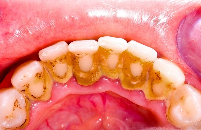 Cao răng là những mảng bám vàng trong răng