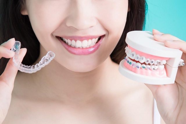 Thời gian niềng răng thường kéo dài từ 1 – 3 năm