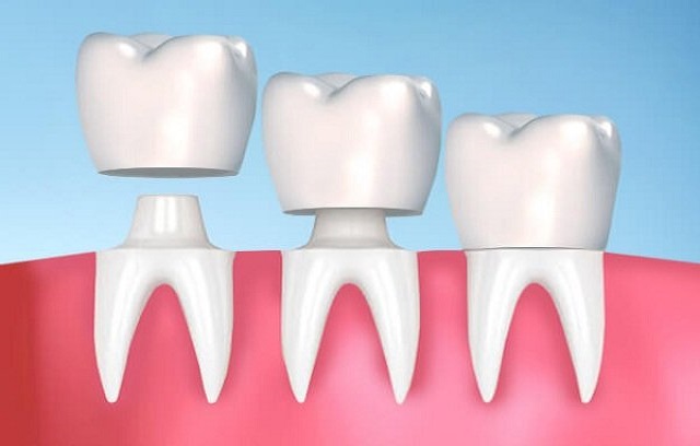 Các loại răng sứ phổ biến hiện nay 